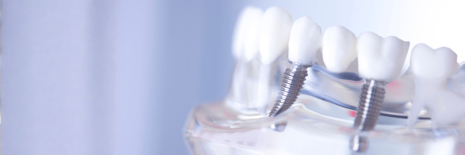 Dental Implants | Dentist