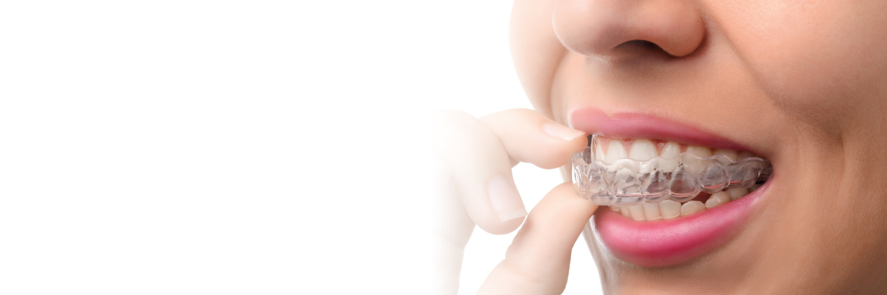 Invisalign® | Dentist